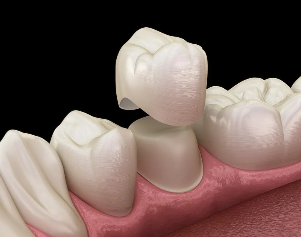 Dental Crown - Ellora Clinic Turkey