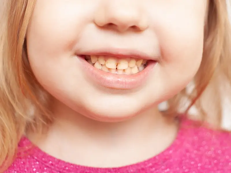 اعوجاج الأسنان اللبنية عند الرضع
