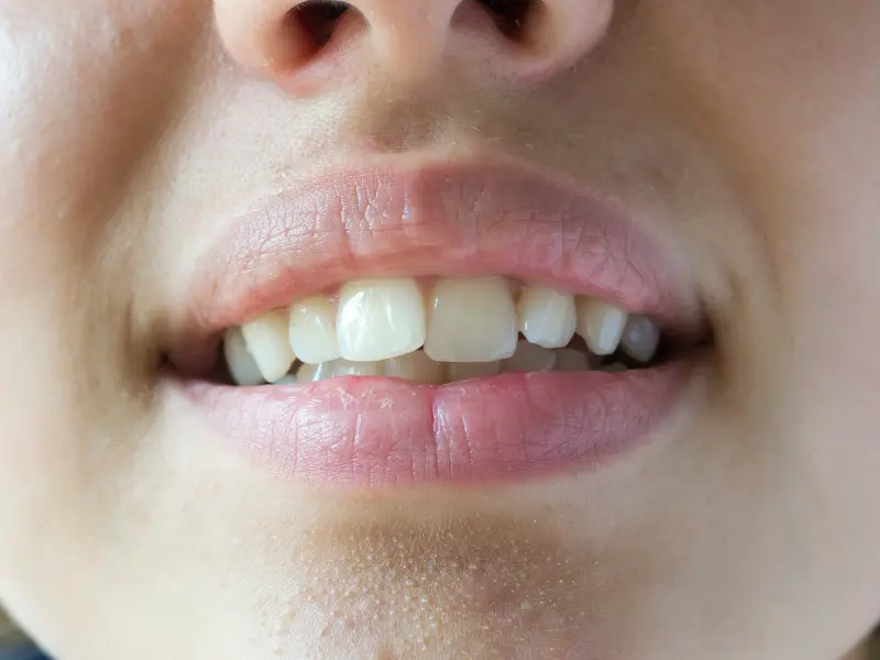 اعوجاج الاسنان تعرف عليها وعلى اسبابها وطرق علاجها