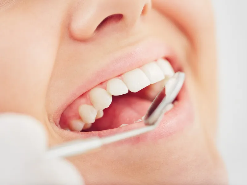 كيف يتم تركيب اسنان الزيركون