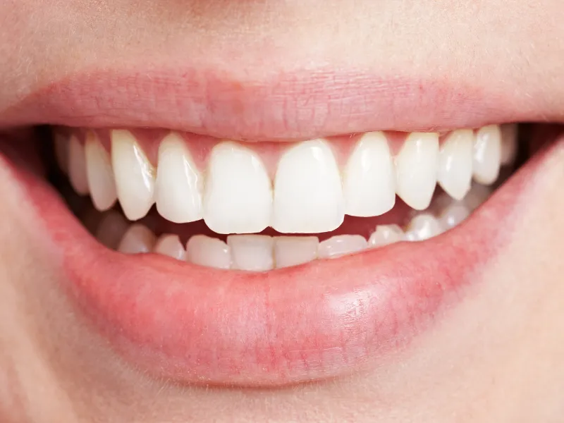 الفرق بين عدسات الاسنان وابتسامة هوليود تعرف عليها