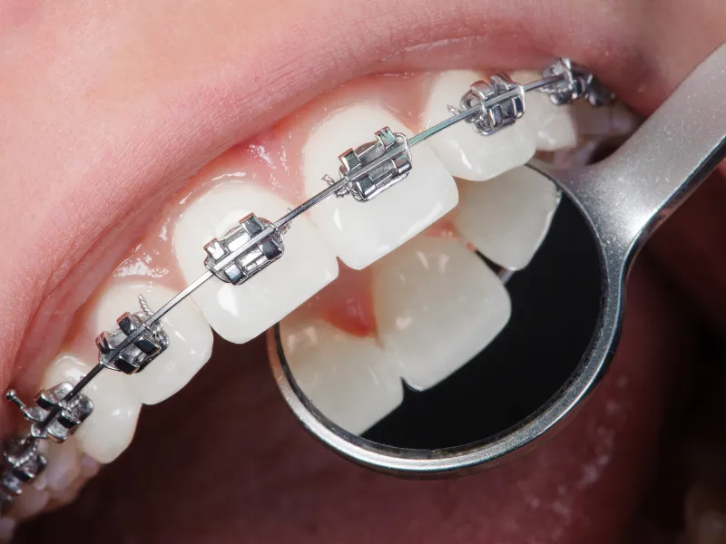 انواع تقويم الاسنان